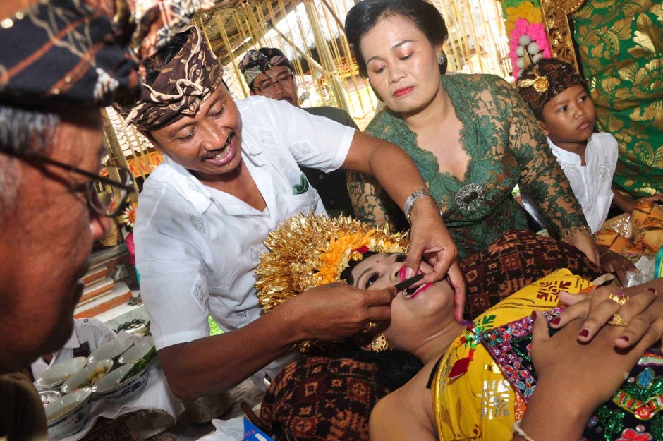 Подпиливание зубов на Бали